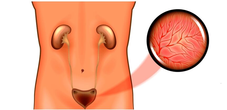 Cistite negli uomini sintomi e trattamento