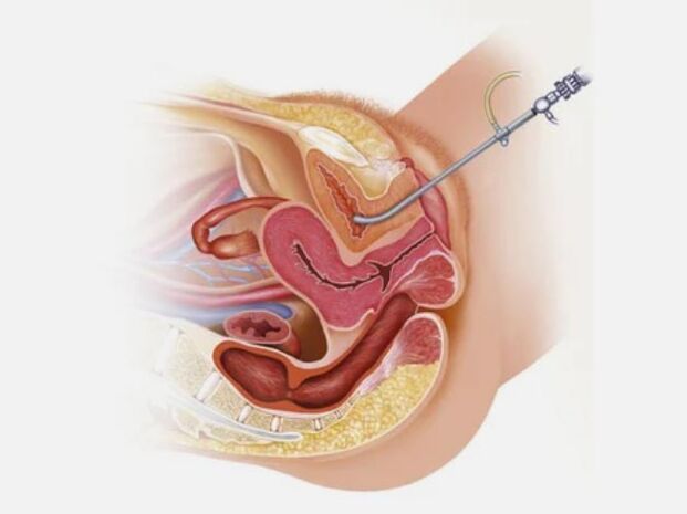 Diagnosi di cistite