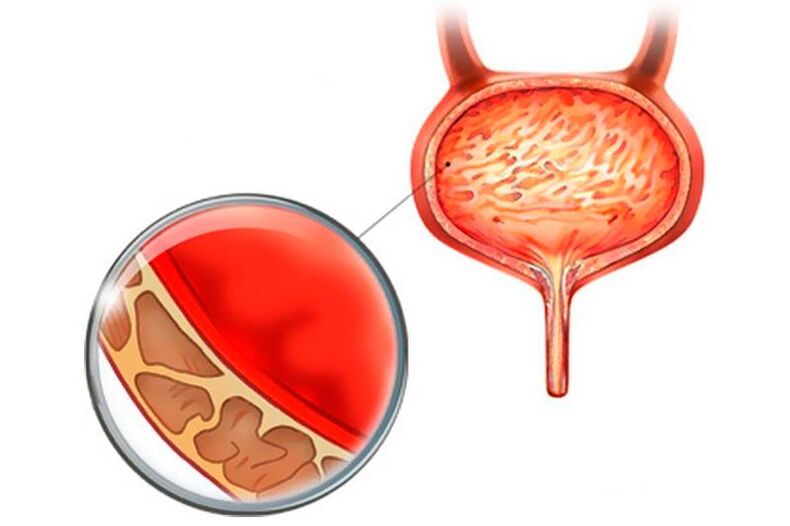 Infiammazione della mucosa della vescica con cistite